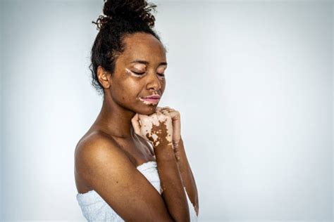 13 000+ Vitiligo Photos, taleaux et images libre de。